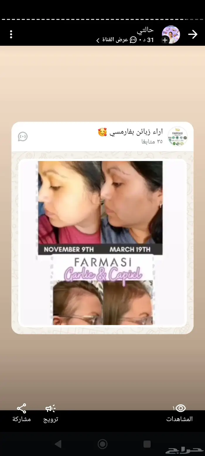 شامبو الثوم والكابيكسل لزراعة الشعر والتحكم بالدهون الفروة 3