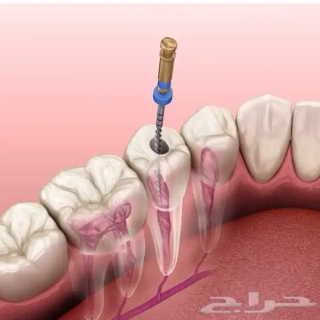 علاج عصب للأسنان الأمامية والضواحك للنساء فقط 0