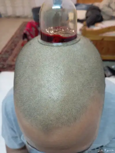 الحجامه الطبيه على السنه النبويه index