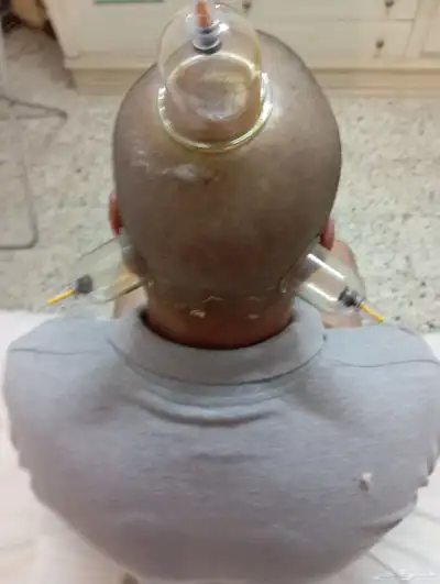 الحجامه الطبيه على السنه النبويه index