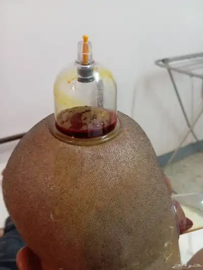 الحجامه الطبيه على السنه النبويه index