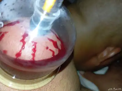 الحجامه الطبيه على السنه النبويه index