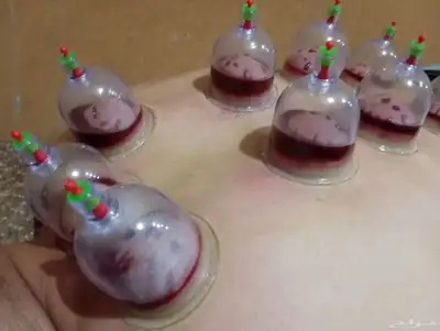 الحجامه الطبيه على السنه النبويه index