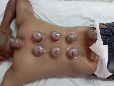 الحجامه الطبيه على السنه النبويه index