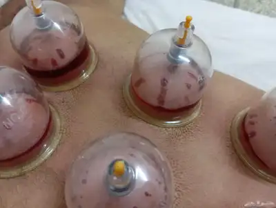 الحجامه الطبيه على السنه النبويه index