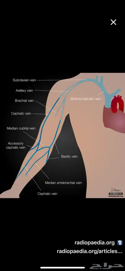 فصد عرق النسا وطريقة مسار العروق index