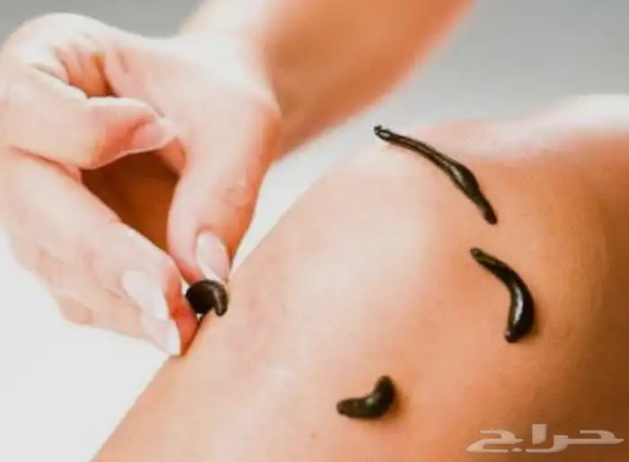 دودة العلق الحكيمه 2