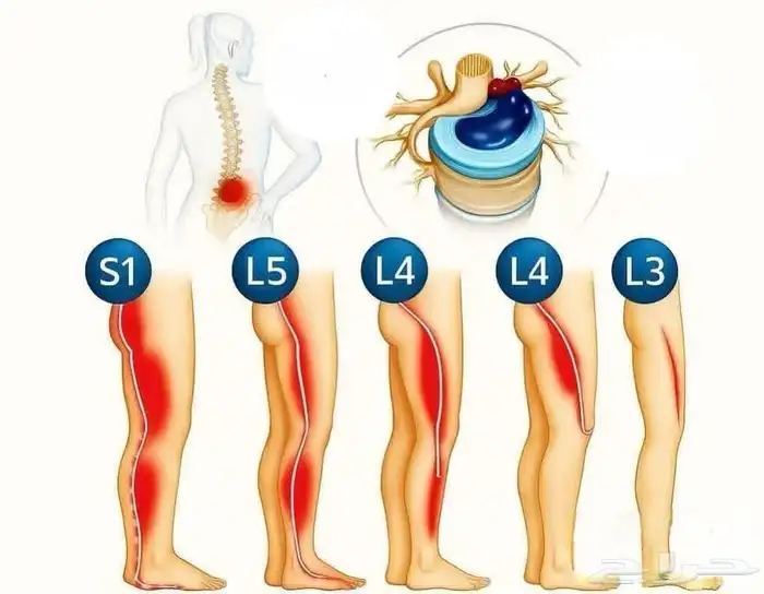الشفاء للحجامة  التداوي بالمسنونة 6