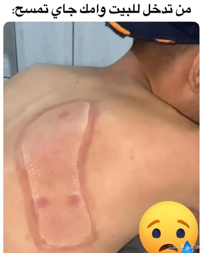 الشفاء للحجامة  التداوي بالمسنونة 4