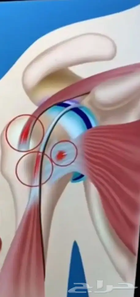 الشفاء للحجامة  التداوي بالمسنونة 2