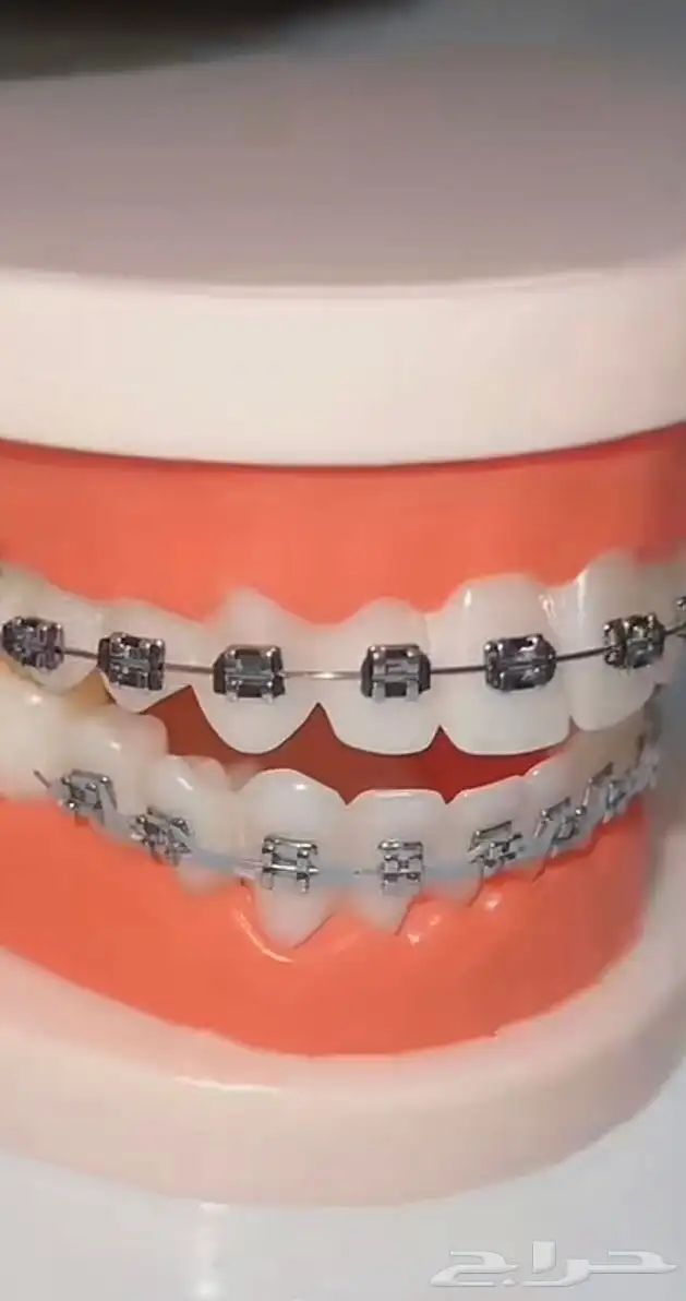 تقويم اسنان 0