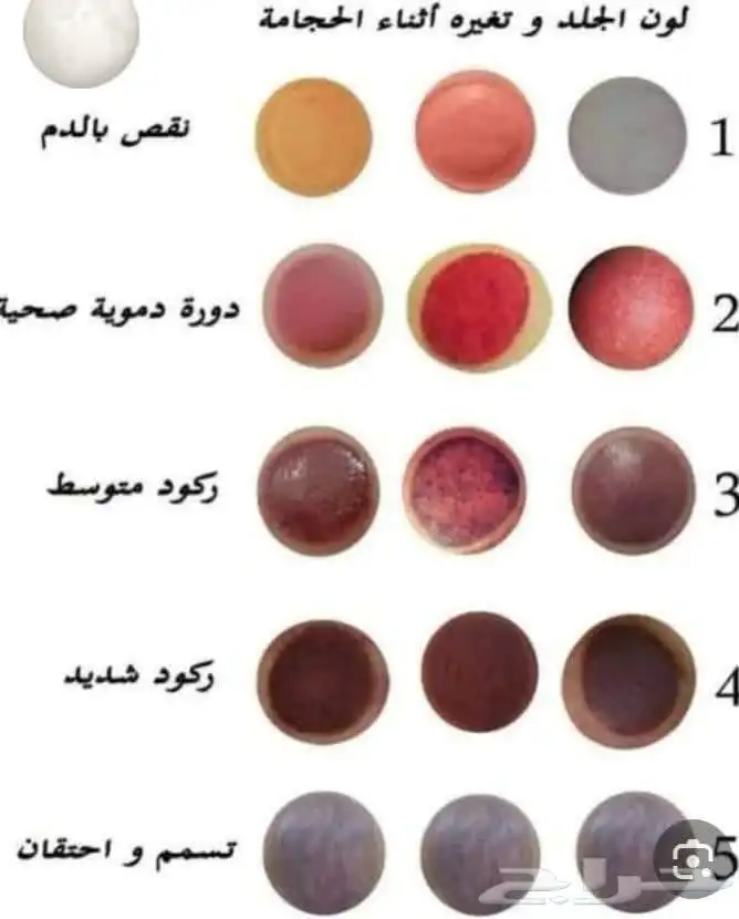 الشفاء للحجامة  التداوي بالمسنونة 0