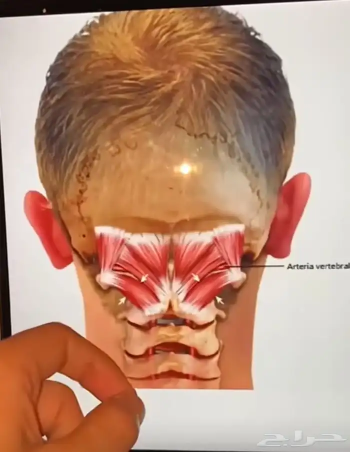 الشفاء للحجامة  التداوي بالمسنونة 10