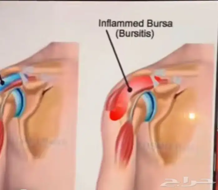 الشفاء للحجامة  التداوي بالمسنونة 7