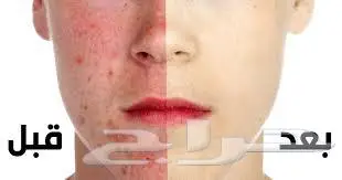 زيراكتان 20 روكتان 20 0