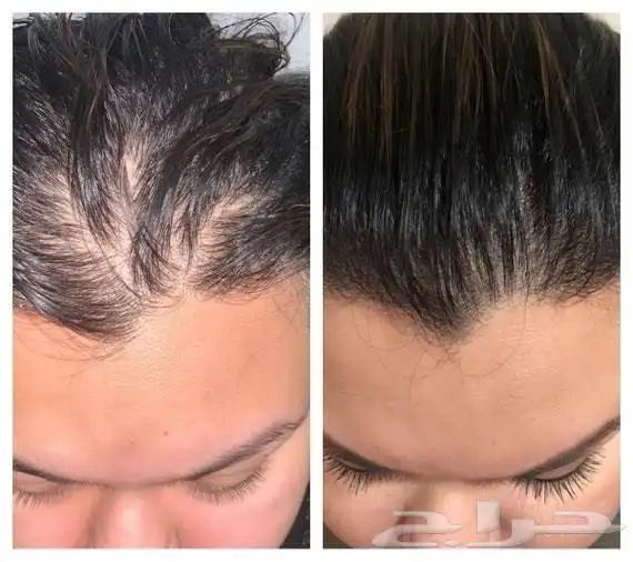 استعد م دمرته الكيماويات 0