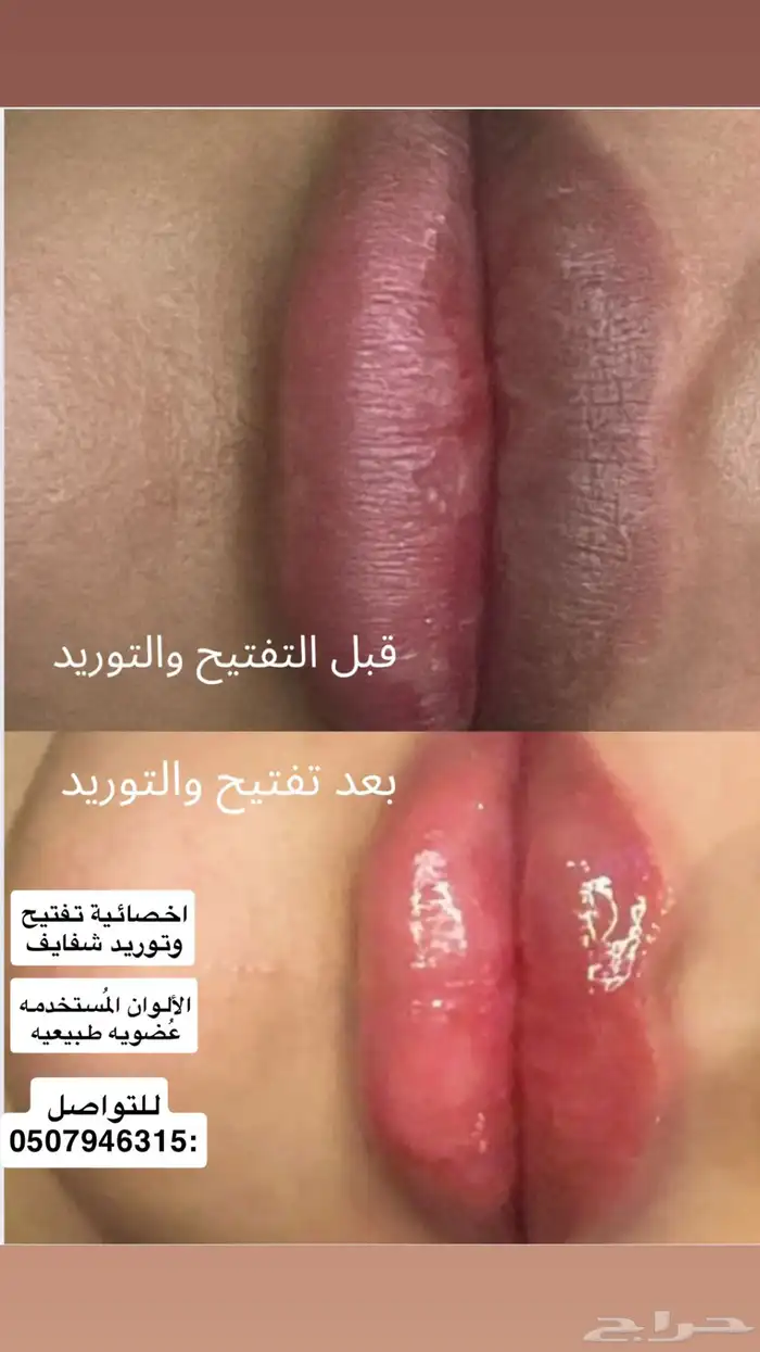 تفتيح وتوريد الشفايف ب تقنية المايكرو ونتائج تنافس العيادات 5