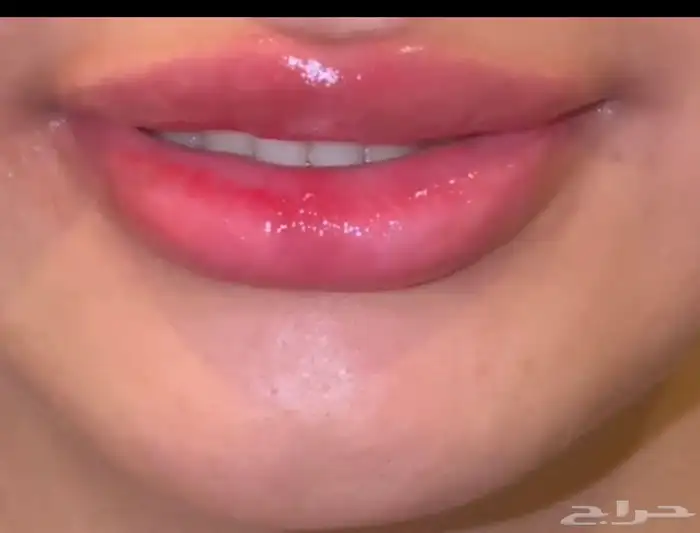 تفتيح وتوريد الشفايف ب تقنية المايكرو ونتائج تنافس العيادات 2