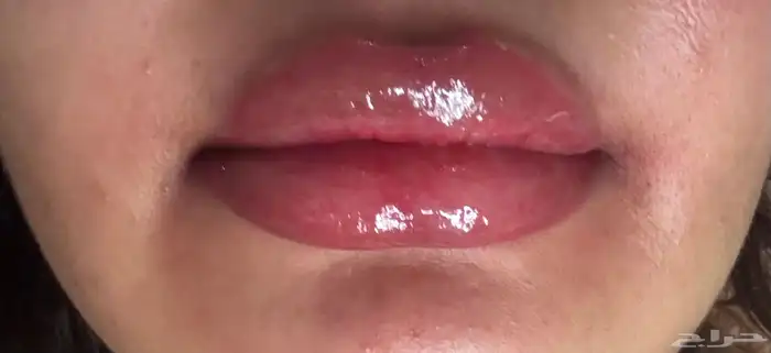 تفتيح وتوريد الشفايف ب تقنية المايكرو ونتائج تنافس العيادات 1