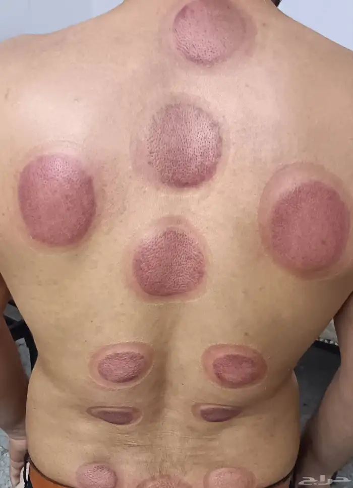 متخصص حجامة منزلية خبرة اكثر من 5 سنوات 1