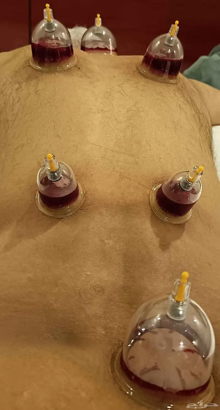 متخصص حجامة منزلية خبرة اكثر من 5 سنوات 4