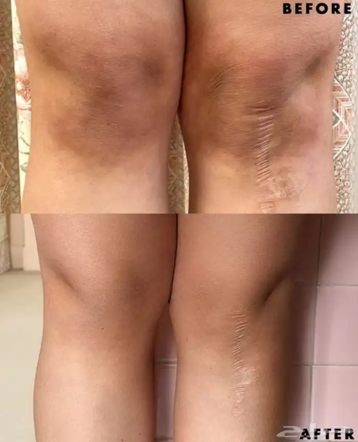 تركيبات تفتيح صيدلانية خاليه من الكرتزون 2