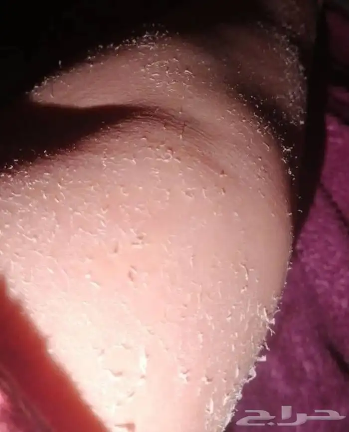 تركيبات تفتيح صيدلانية خاليه من الكرتزون 8