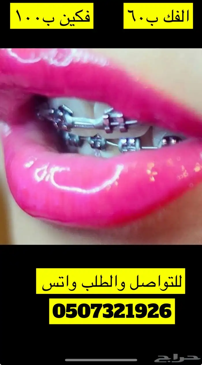 تقويم أسنان زينه 0