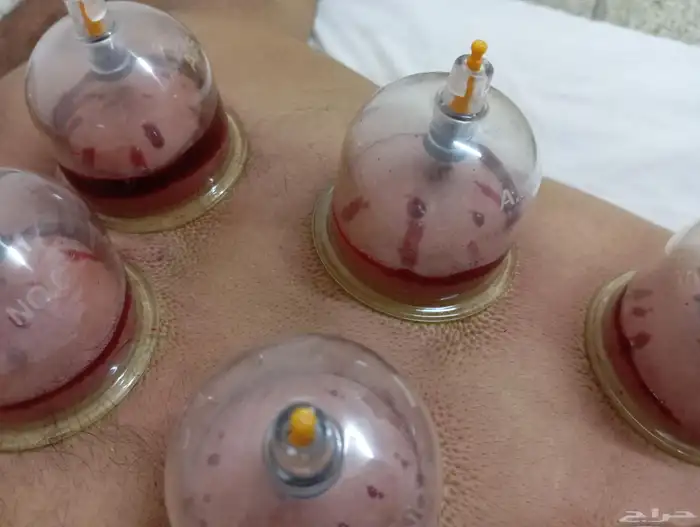 حجامه طبيه على السنه النبويه 1