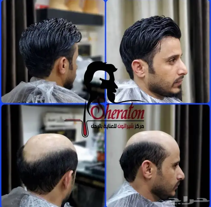 شعر باروكات استرالي شبكيه كثافه عاليه درجه اولى 0