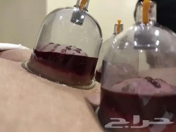 اخصائي حجامه زيارات منزليه 13