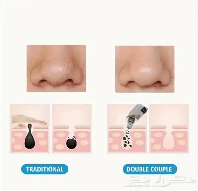 جهاز تنظيف الرؤوس السوداء والمسام 3