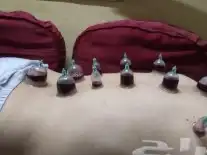 اخصائي حجامه زيارات منزليه 2