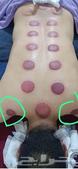 ابو عبدالله الخوارزمي للحجامة والمساج وفك الابهر 8