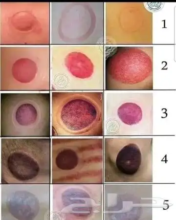 ابو عبدالله الخوارزمي للحجامة والمساج وفك الابهر 6