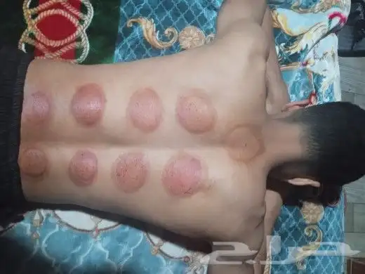 ابو عبدالله الخوارزمي للحجامة والمساج وفك الابهر 5