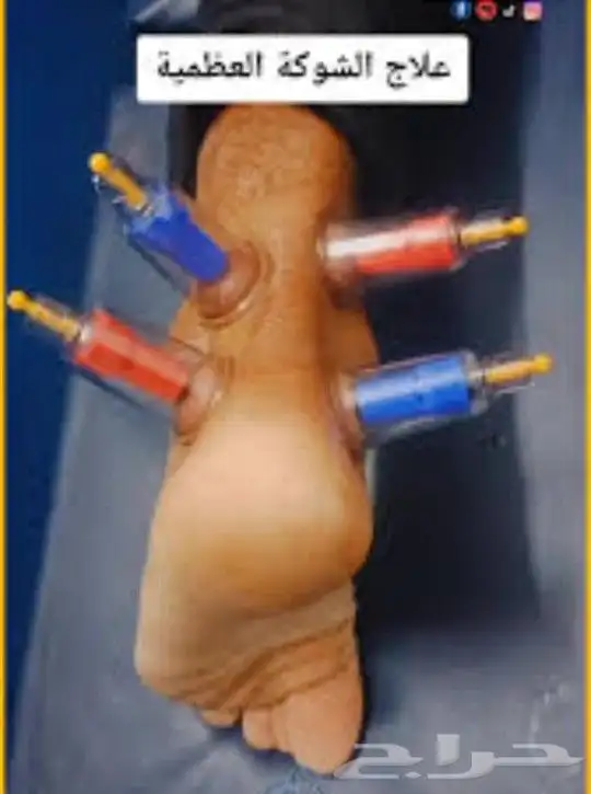 ابو عبدالله الخوارزمي للحجامة والمساج وفك الابهر 0