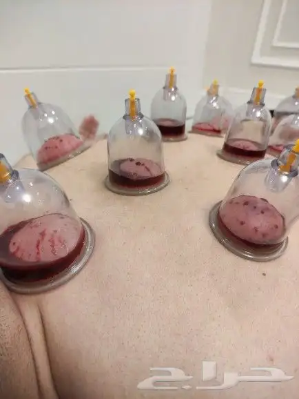 متخصص حجامه منزليه خبره اكثر من 5 سنوات 1