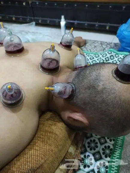 متخصص حجامه منزليه خبره اكثر من 5 سنوات 0