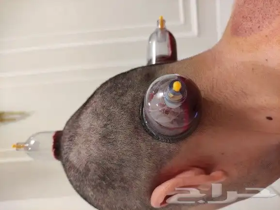 متخصص حجامه منزليه خبره اكثر من 5 سنوات 2