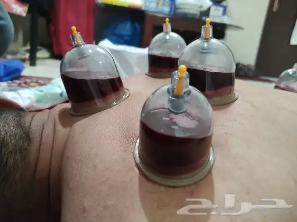 اخصائي حجامه زيارات منزليه 16