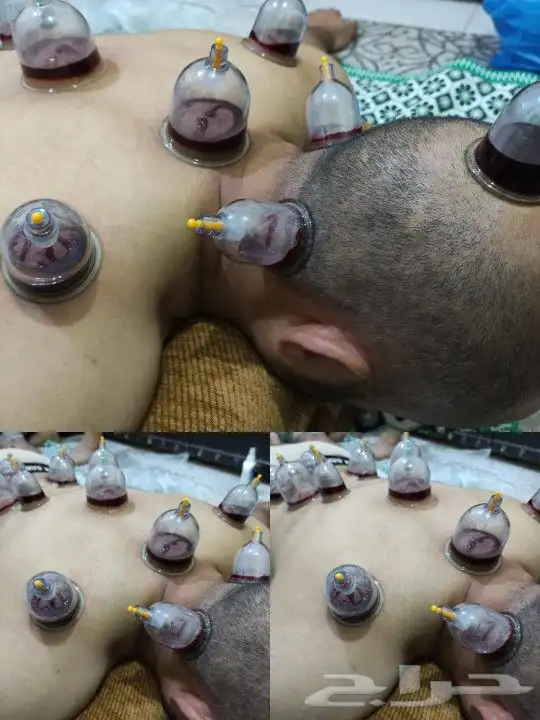 متخصص حجامه منزليه خبره اكثر من 5 سنوات 3