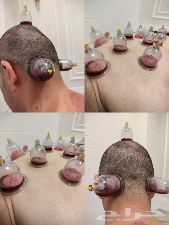 متخصص حجامه منزليه خبره اكثر من 5 سنوات 2
