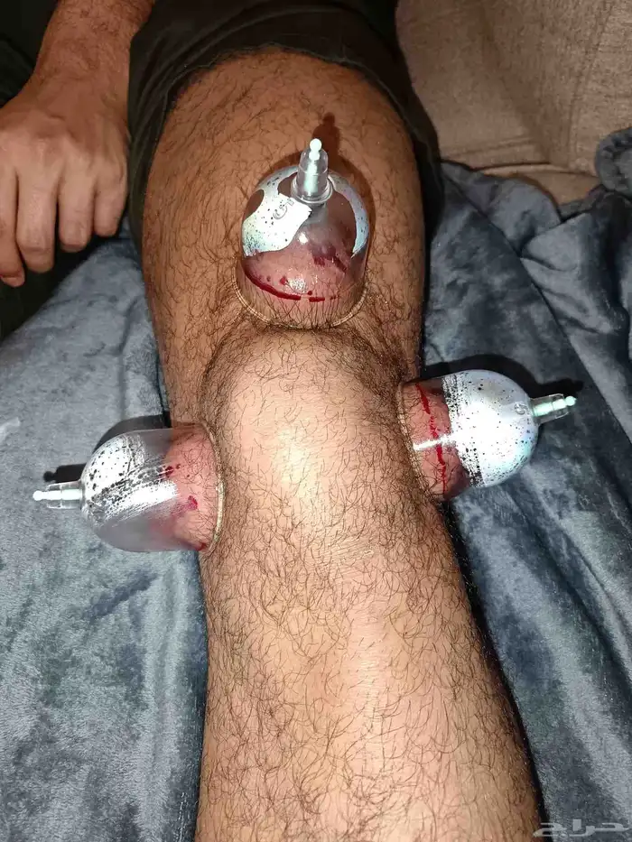 متخصص حجامة منزلية خبرة اكثر من 5 سنوات في الحجامة الشرعية 8