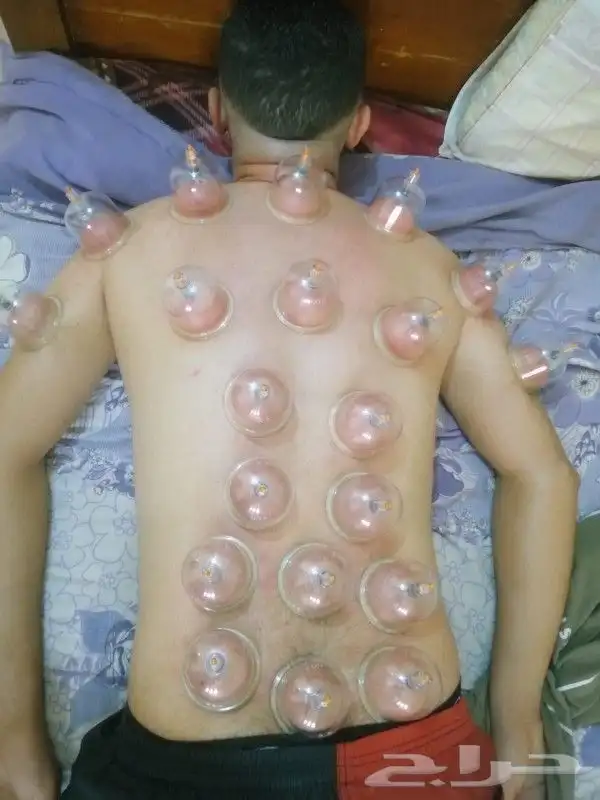 متخصص حجامة منزلية خبرة اكثر من 5 سنوات 3
