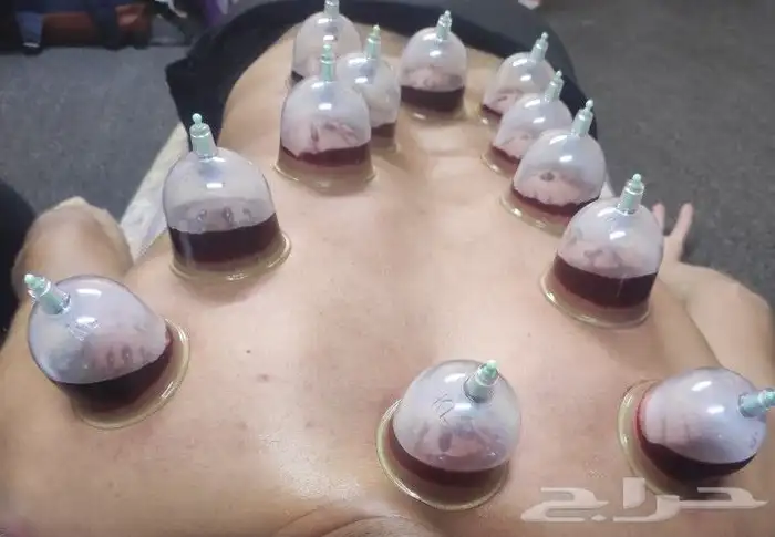 متخصص حجامه  منزليه خبره طويله اكثر 5سنوات 0