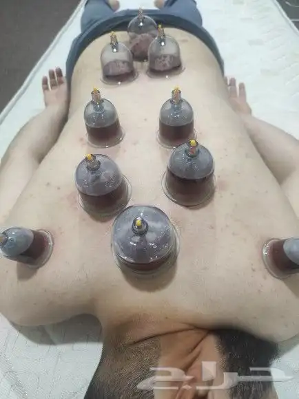 اخصائي حجامه زيارات منزليه 19