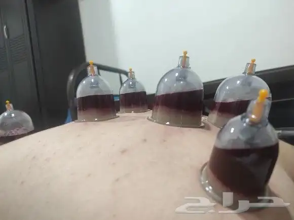 اخصائي حجامه زيارات منزليه 18