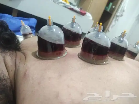اخصائي حجامه زيارات منزليه 17