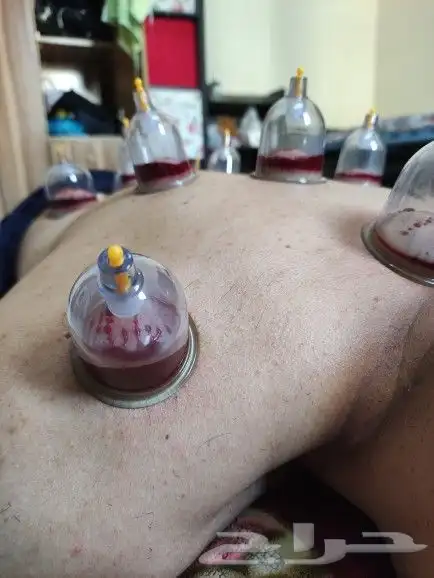 متخصص حجامه  منزليه خبره اكثر 5 سنوات 4